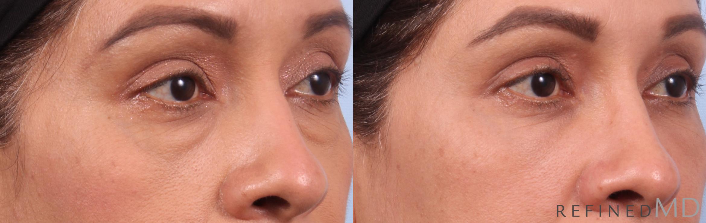 Before & After Lower Eyelid Case 1137 Right Oblique View in Los Gatos & San Jose, CA