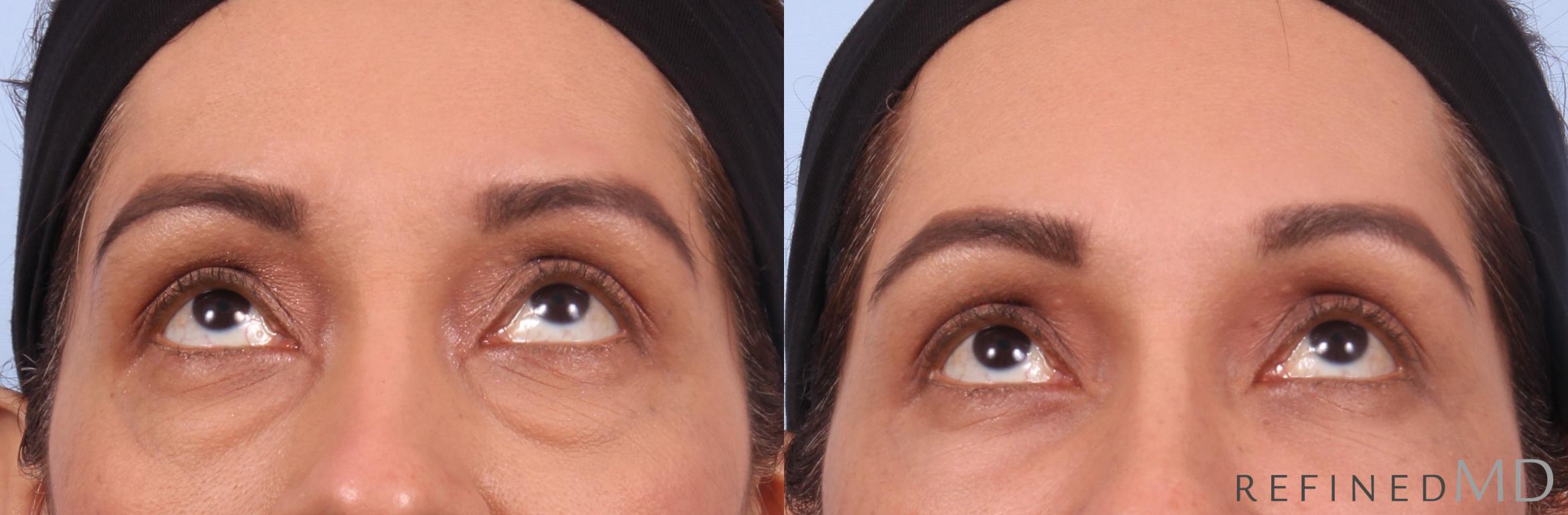 Before & After Lower Eyelid Case 1137 Up Gaze View in Los Gatos & San Jose, CA