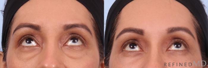 Before & After Lower Eyelid Case 1137 Up Gaze View in Los Gatos & San Jose, CA