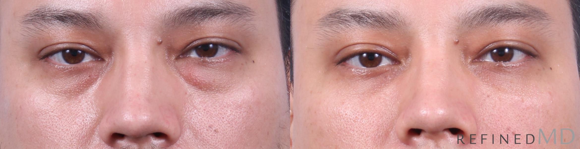 Before & After Lower Eyelid Case 1138 Front View in Los Gatos & San Jose, CA