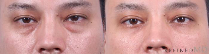 Before & After Lower Eyelid Case 1138 Front View in Los Gatos & San Jose, CA