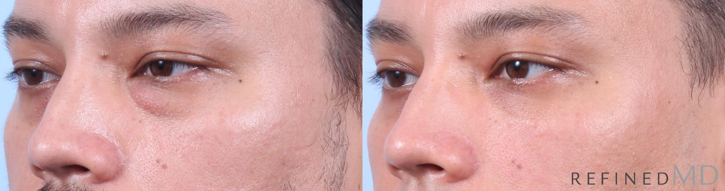 Before & After Lower Eyelid Case 1138 Left Oblique View in Los Gatos & San Jose, CA