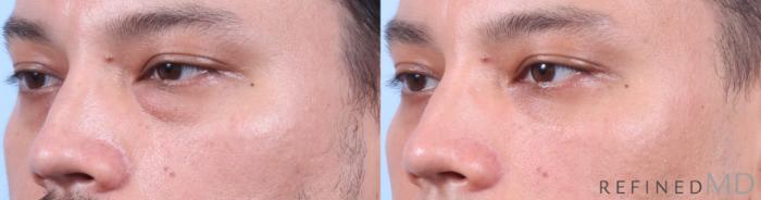 Before & After Lower Eyelid Case 1138 Left Oblique View in Los Gatos & San Jose, CA