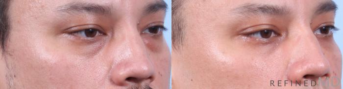 Before & After Lower Eyelid Case 1138 Right Oblique View in Los Gatos & San Jose, CA