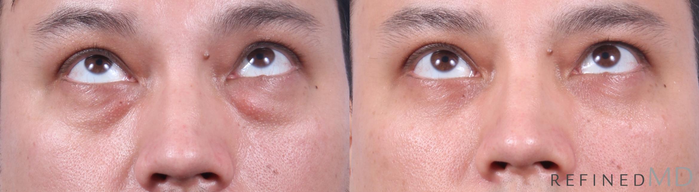 Before & After Lower Eyelid Case 1138 Up Gaze View in Los Gatos & San Jose, CA