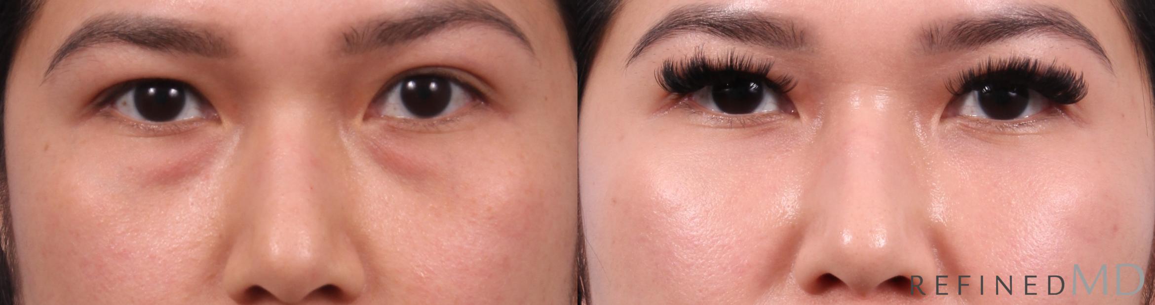 Before & After Lower Eyelid Case 1139 Front View in Los Gatos & San Jose, CA