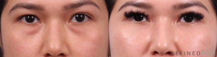 Before & After Lower Eyelid Case 1139 Front View in Los Gatos & San Jose, CA
