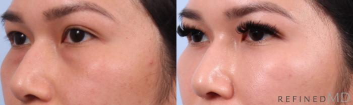 Before & After Lower Eyelid Case 1139 Left Oblique View in Los Gatos & San Jose, CA