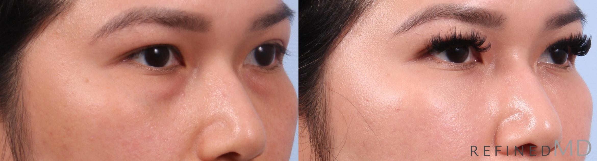 Before & After Lower Eyelid Case 1139 Right Oblique View in Los Gatos & San Jose, CA