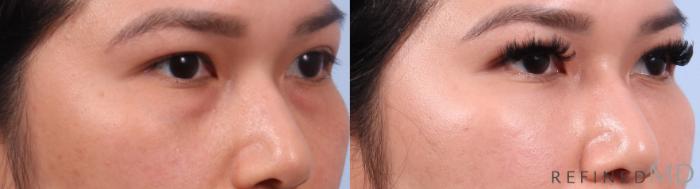 Before & After Lower Eyelid Case 1139 Right Oblique View in Los Gatos & San Jose, CA