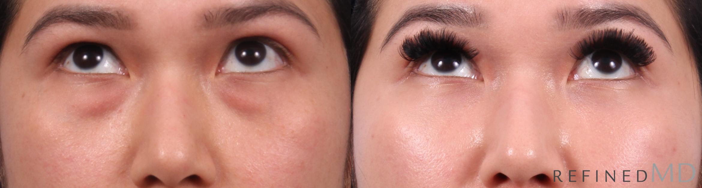 Before & After Lower Eyelid Case 1139 Up Gaze View in Los Gatos & San Jose, CA