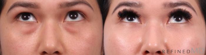 Before & After Lower Eyelid Case 1139 Up Gaze View in Los Gatos & San Jose, CA
