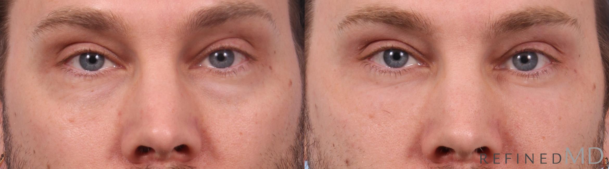 Before & After Lower Eyelid Case 1140 Front View in Los Gatos & San Jose, CA