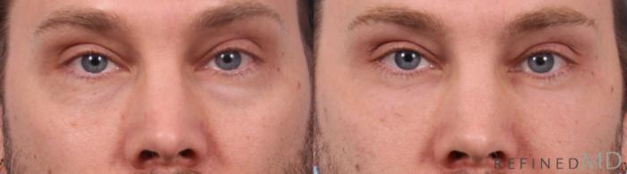 Before & After Lower Eyelid Case 1140 Front View in Los Gatos & San Jose, CA