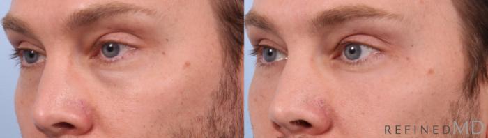 Before & After Lower Eyelid Case 1140 Left Oblique View in Los Gatos & San Jose, CA