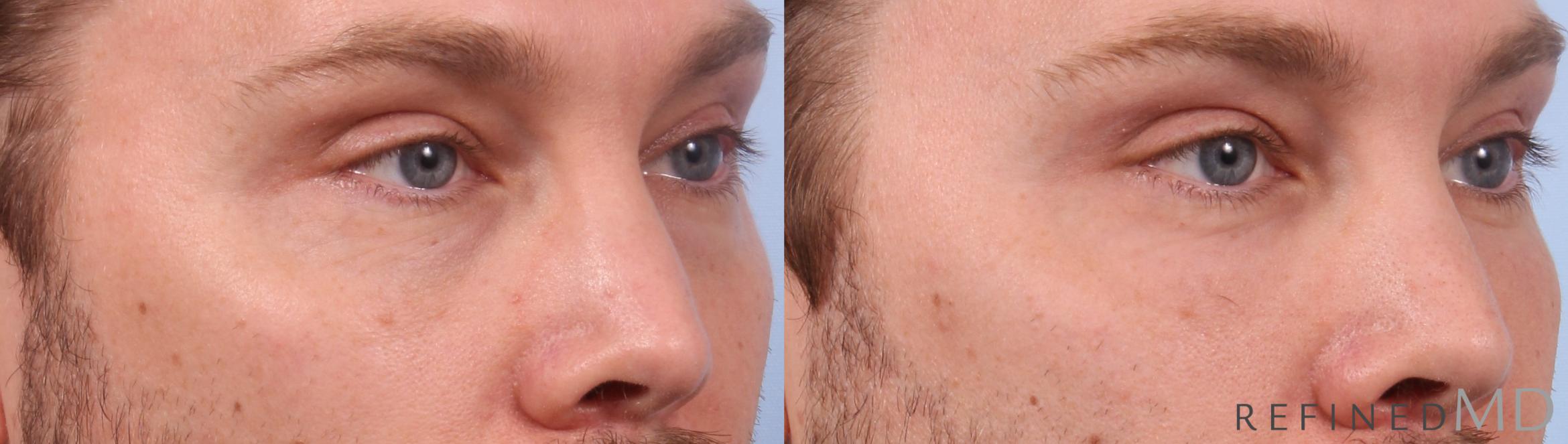 Before & After Lower Eyelid Case 1140 Right Oblique View in Los Gatos & San Jose, CA