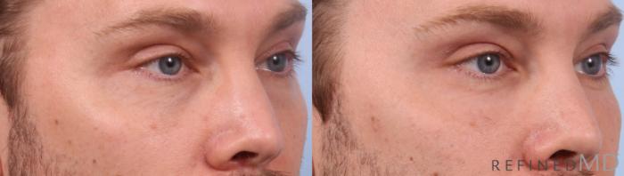 Before & After Lower Eyelid Case 1140 Right Oblique View in Los Gatos & San Jose, CA