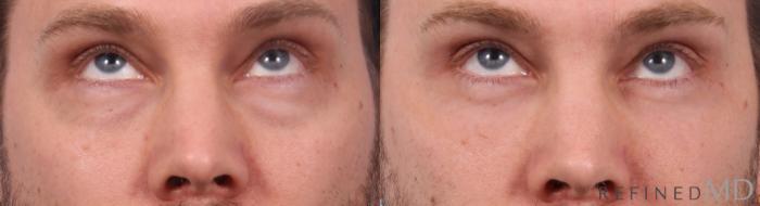 Before & After Lower Eyelid Case 1140 Up Gaze View in Los Gatos & San Jose, CA