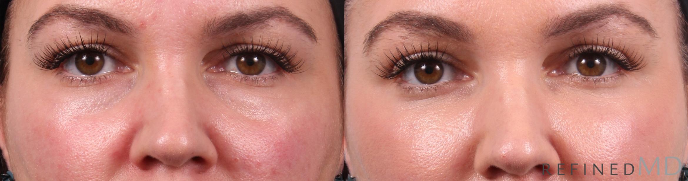 Before & After Lower Eyelid Case 1141 Front View in Los Gatos & San Jose, CA