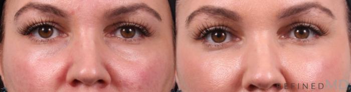 Before & After Lower Eyelid Case 1141 Front View in Los Gatos & San Jose, CA