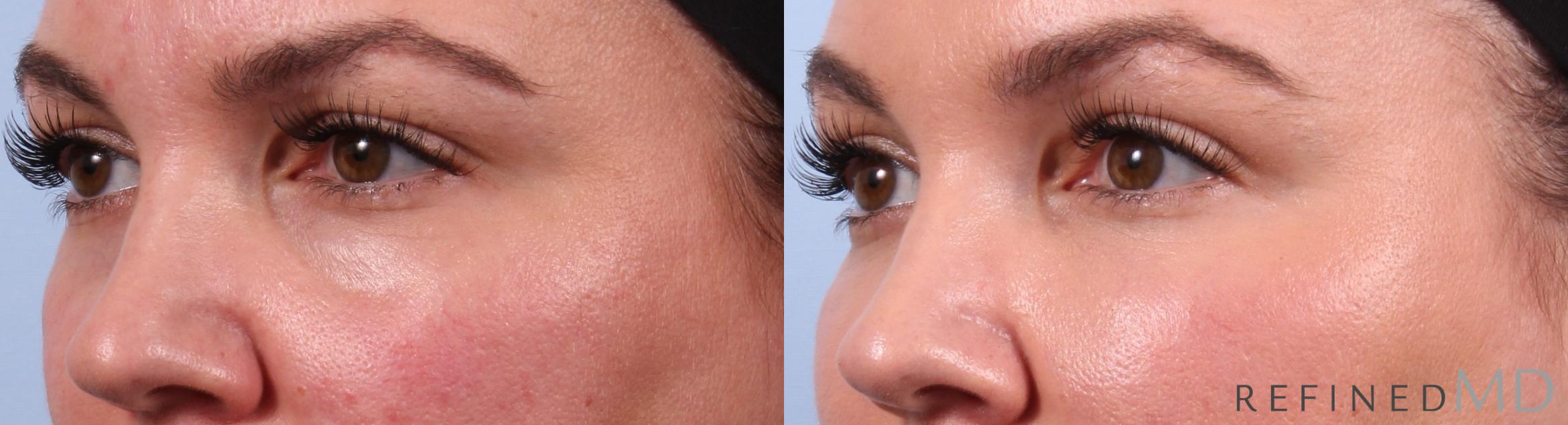 Before & After Lower Eyelid Case 1141 Left Oblique View in Los Gatos & San Jose, CA