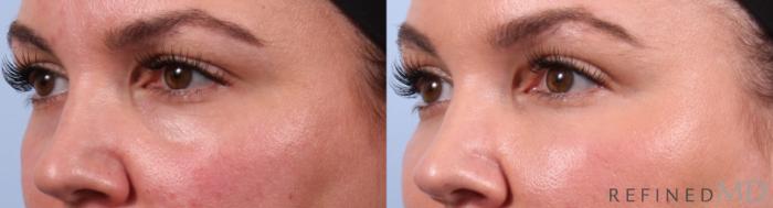 Before & After Lower Eyelid Case 1141 Left Oblique View in Los Gatos & San Jose, CA