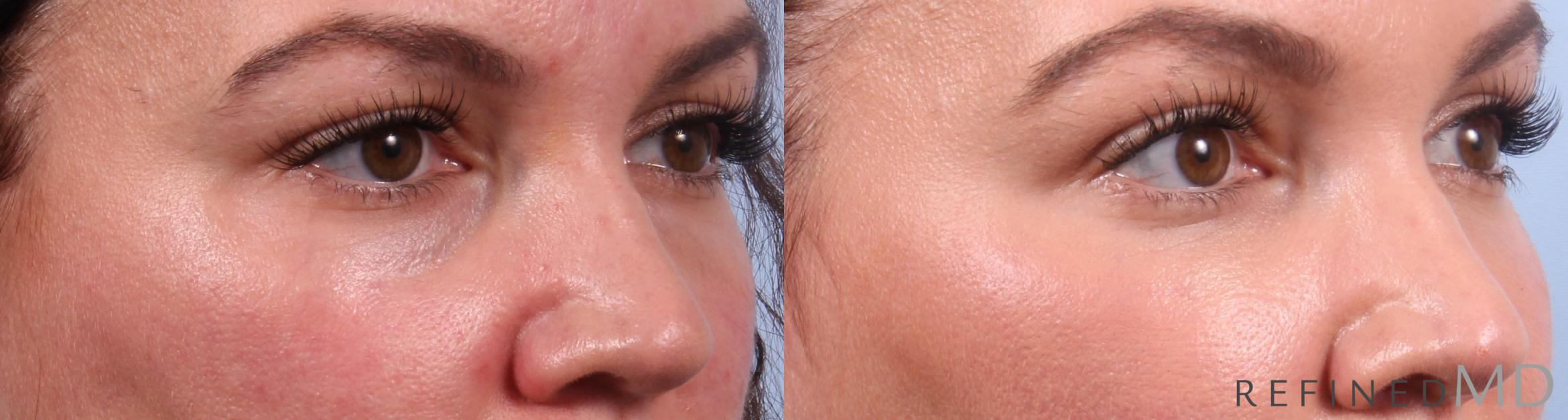 Before & After Lower Eyelid Case 1141 Right Oblique View in Los Gatos & San Jose, CA