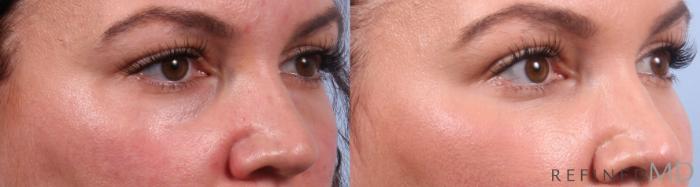 Before & After Lower Eyelid Case 1141 Right Oblique View in Los Gatos & San Jose, CA