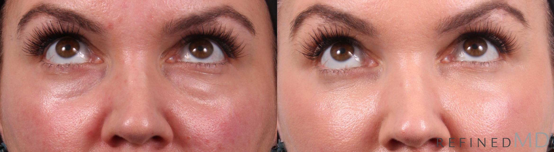 Before & After Lower Eyelid Case 1141 Up Gaze View in Los Gatos & San Jose, CA