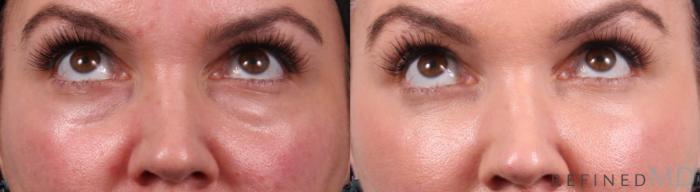 Before & After Lower Eyelid Case 1141 Up Gaze View in Los Gatos & San Jose, CA
