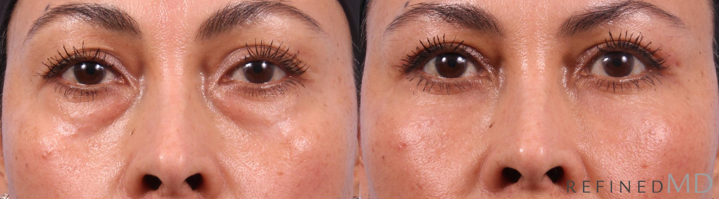 Before & After Lower Eyelid Case 1142 Front View in Los Gatos & San Jose, CA