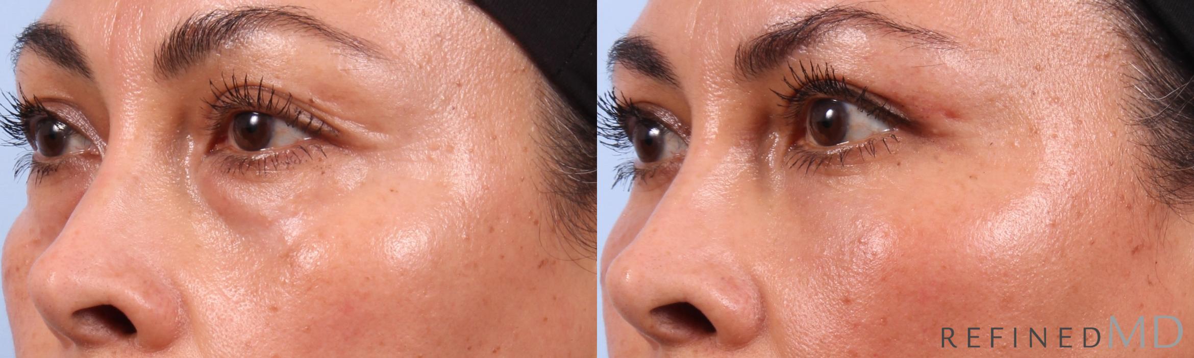 Before & After Lower Eyelid Case 1142 Left Oblique View in Los Gatos & San Jose, CA