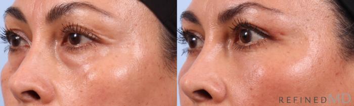 Before & After Lower Eyelid Case 1142 Left Oblique View in Los Gatos & San Jose, CA