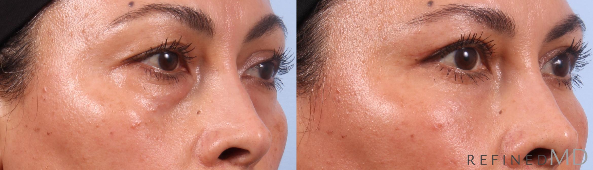 Before & After Lower Eyelid Case 1142 Right Oblique View in Los Gatos & San Jose, CA