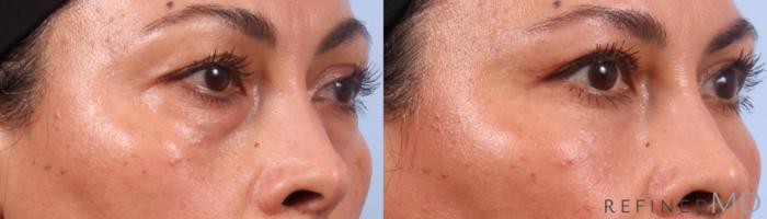 Before & After Lower Eyelid Case 1142 Right Oblique View in Los Gatos & San Jose, CA
