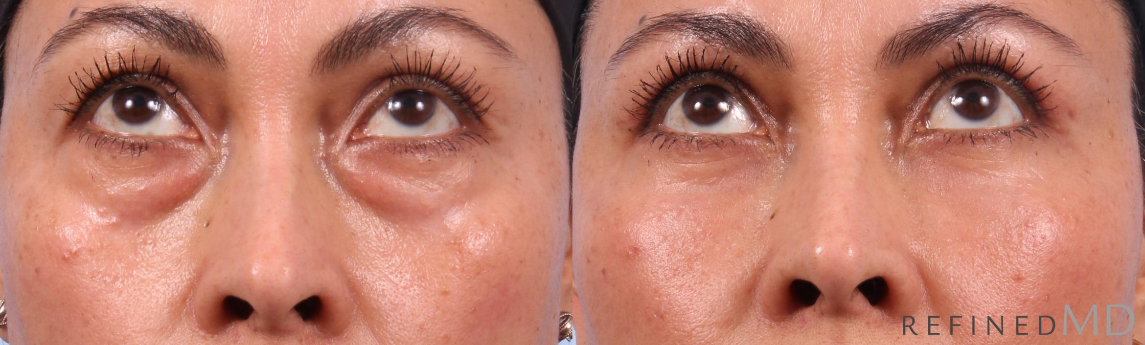 Before & After Lower Eyelid Case 1142 Up Gaze View in Los Gatos & San Jose, CA