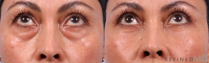 Before & After Lower Eyelid Case 1142 Up Gaze View in Los Gatos & San Jose, CA