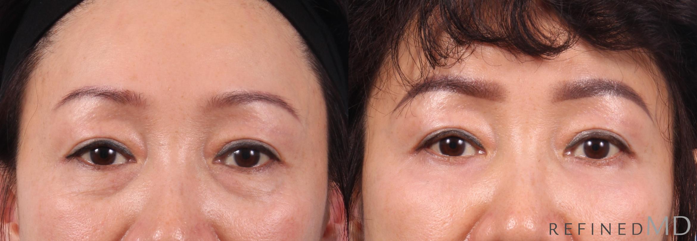 Before & After Lower Eyelid Case 1143 Front View in Los Gatos & San Jose, CA