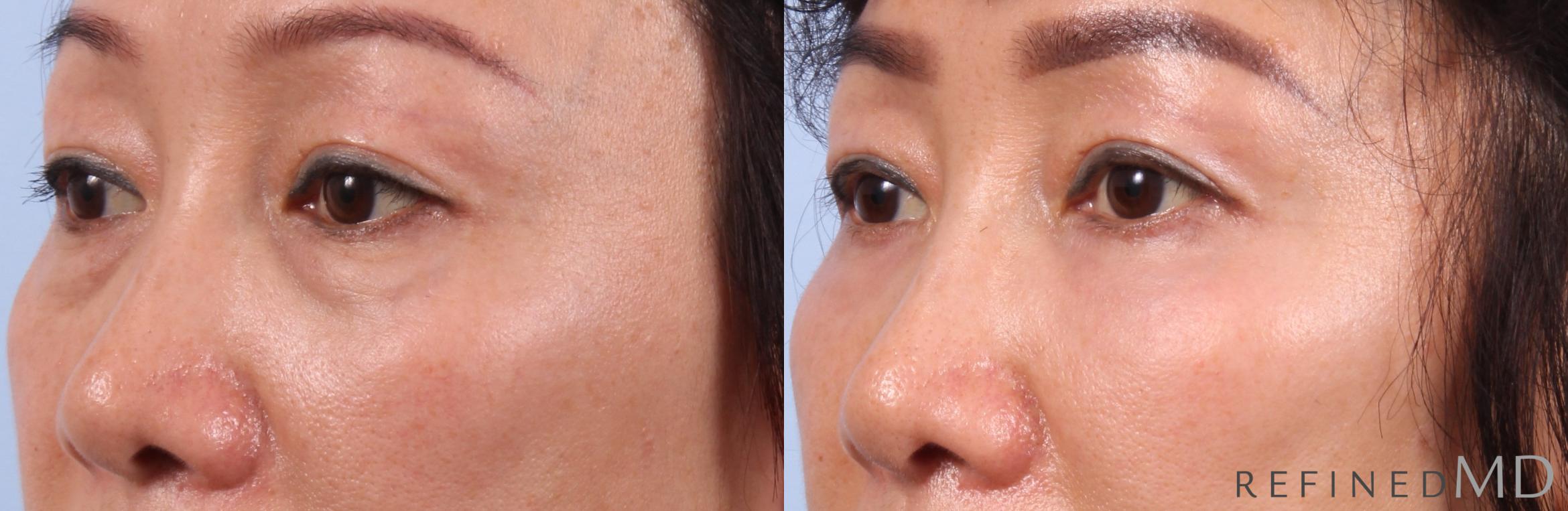 Before & After Lower Eyelid Case 1143 Left Oblique View in Los Gatos & San Jose, CA