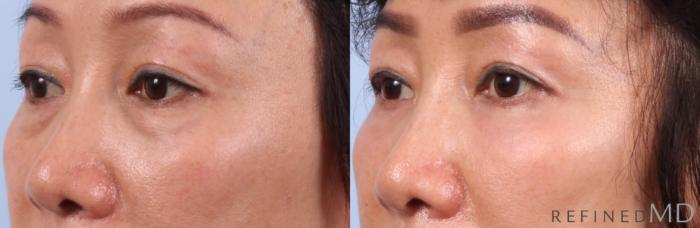 Before & After Lower Eyelid Case 1143 Left Oblique View in Los Gatos & San Jose, CA