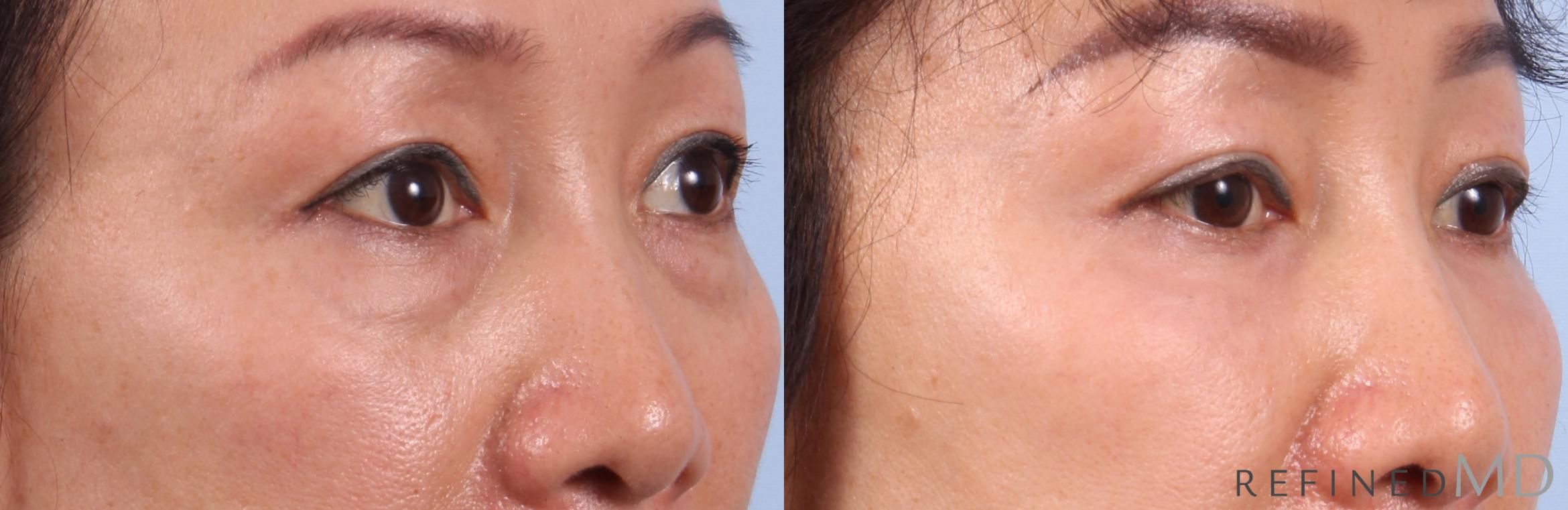Before & After Lower Eyelid Case 1143 Right Oblique View in Los Gatos & San Jose, CA