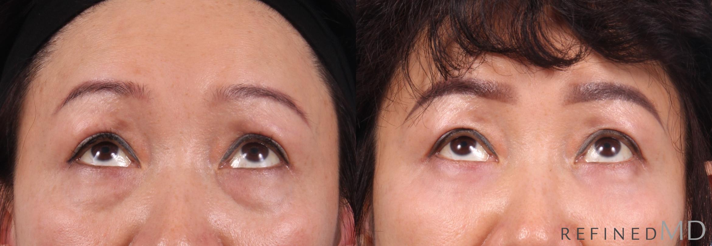 Before & After Lower Eyelid Case 1143 Up Gaze View in Los Gatos & San Jose, CA