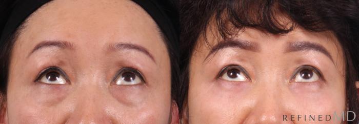 Before & After Lower Eyelid Case 1143 Up Gaze View in Los Gatos & San Jose, CA