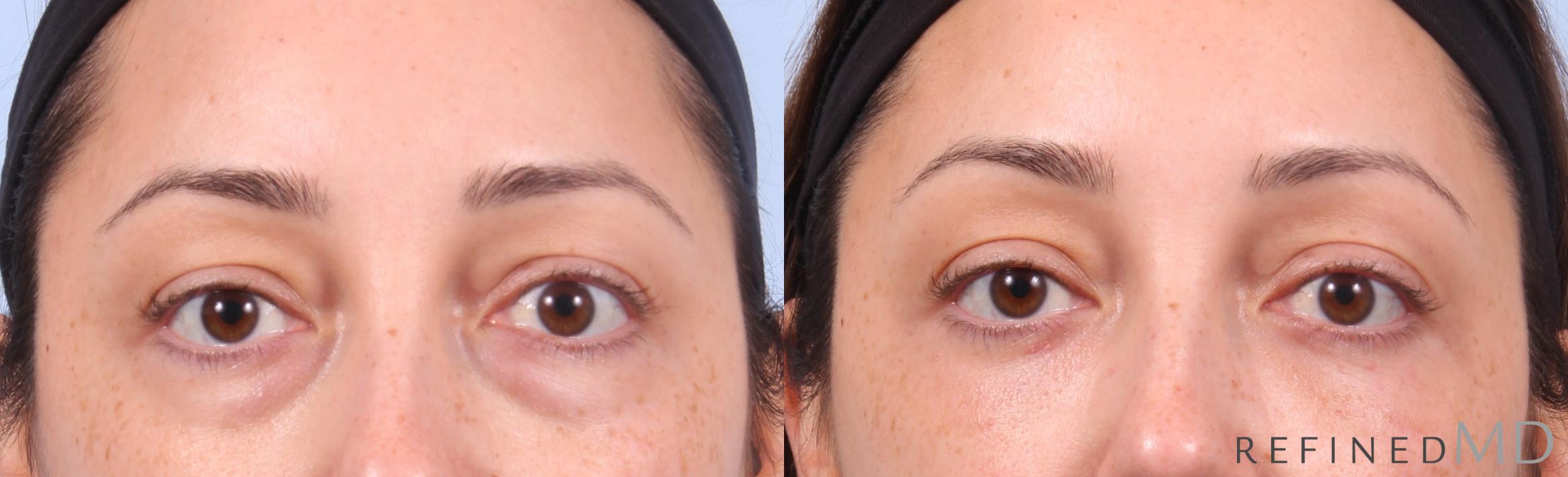 Before & After Lower Eyelid Case 1144 Front View in Los Gatos & San Jose, CA