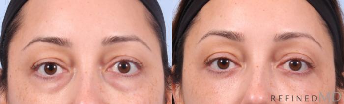 Before & After Lower Eyelid Case 1144 Front View in Los Gatos & San Jose, CA