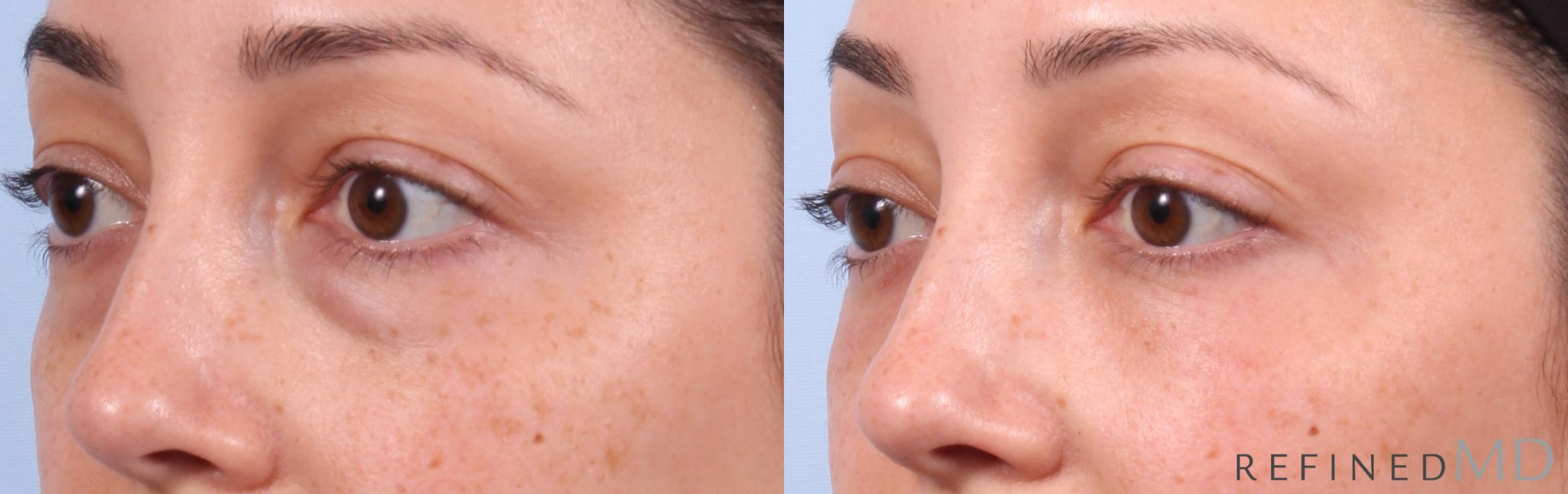Before & After Lower Eyelid Case 1144 Left Oblique View in Los Gatos & San Jose, CA