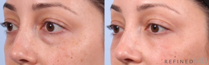 Before & After Lower Eyelid Case 1144 Left Oblique View in Los Gatos & San Jose, CA