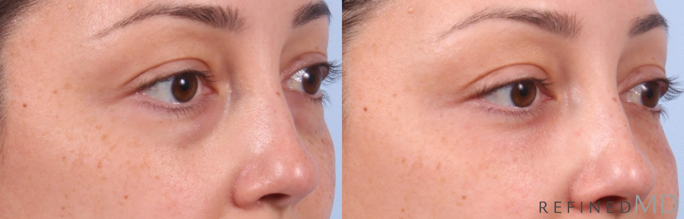 Before & After Lower Eyelid Case 1144 Right Oblique View in Los Gatos & San Jose, CA