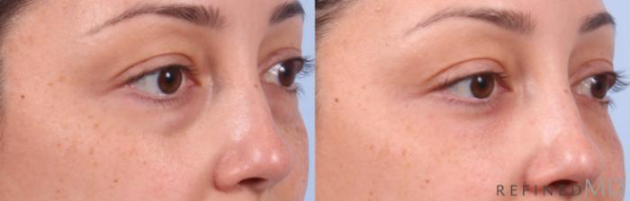 Before & After Lower Eyelid Case 1144 Right Oblique View in Los Gatos & San Jose, CA