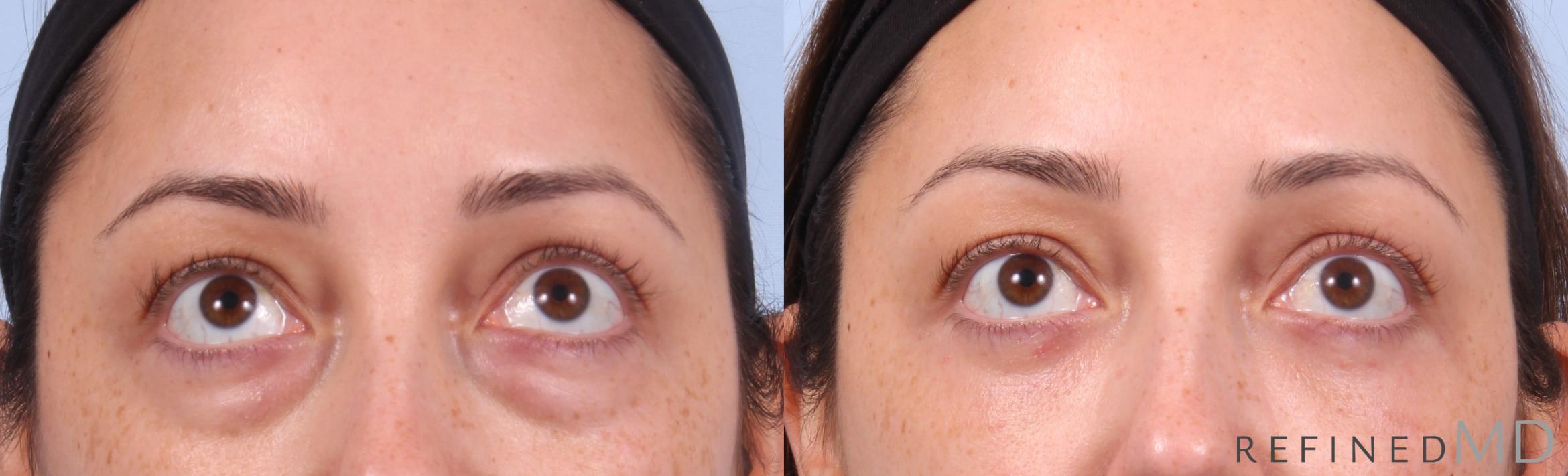 Before & After Lower Eyelid Case 1144 Up Gaze View in Los Gatos & San Jose, CA